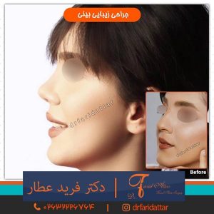 اقدامات قبل از جراحی بینی